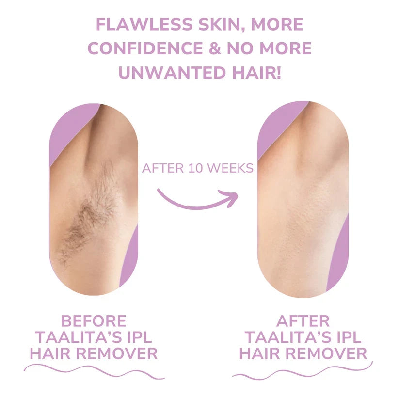 IPL Hair Remover